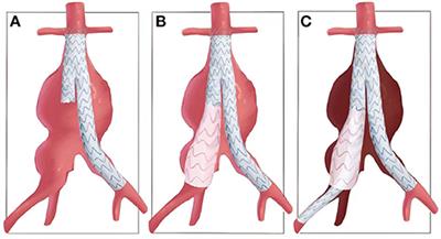 Application of a Novel Common-Iliac-Artery Skirt Technology (CST) in Treating Challenge Aorto-Iliac or Isolated Iliac Artery Aneurysms